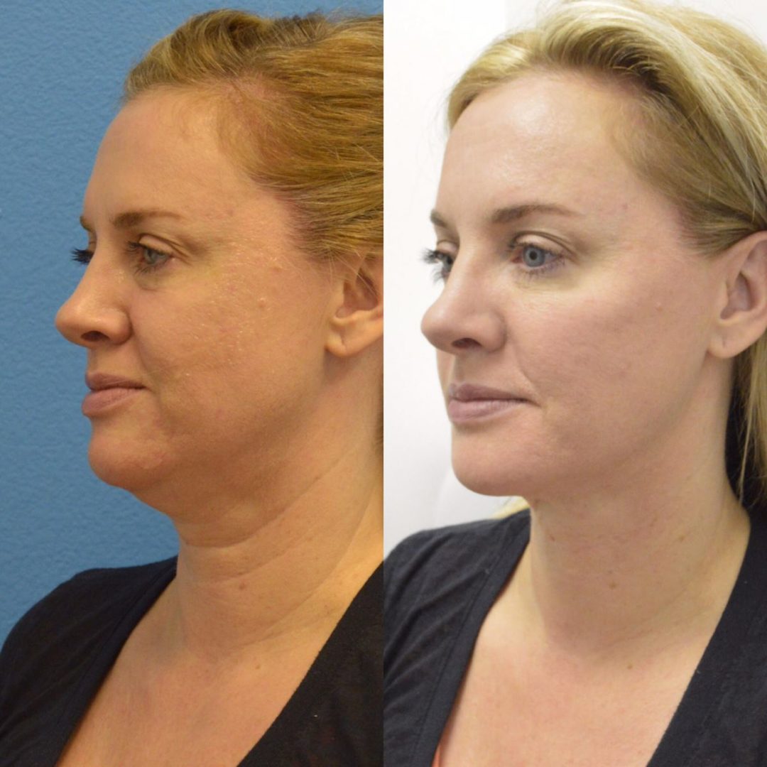 Before & After ModernArt MedSpa & Salon